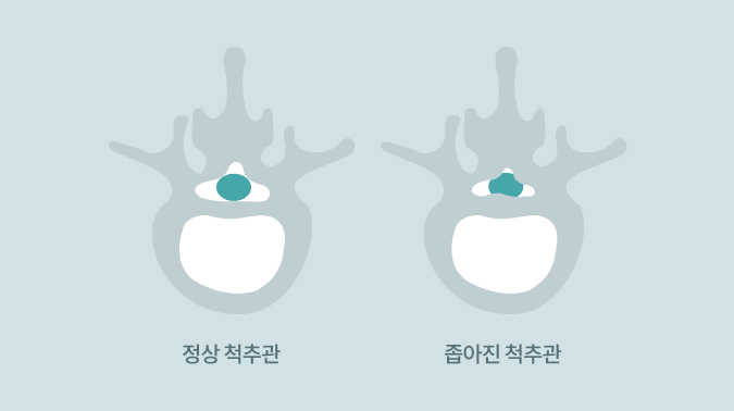 부산척추관협착증