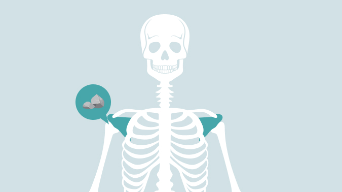 부산석회성건염